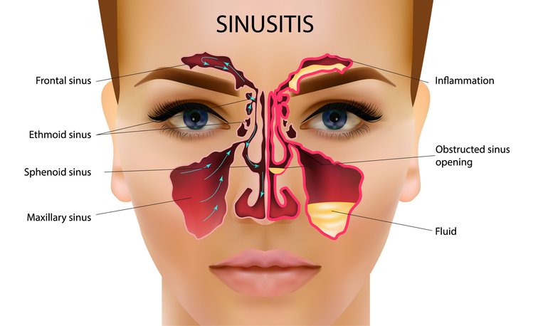 Sinus problems? Natural solutions that work | Health and Nutrition ...